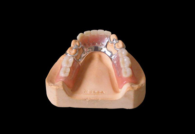 Combined tooth prosthesia 